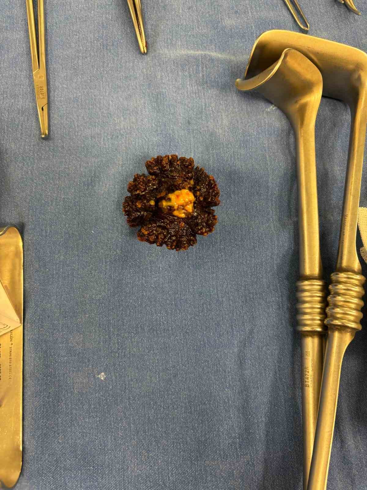 80 yaşındaki hastanın mesanesinden 7 santimetre uzunluğunda taş çıkarıldı